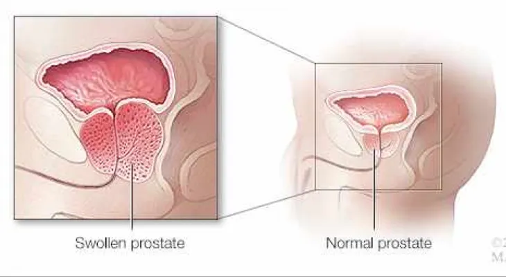 Algunos tipos de prostatitis pueden ser difíciles de tratar