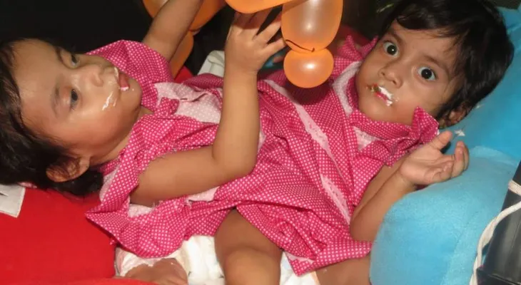 Las siamesas Rositas fueron separadas con éxito tras 17 horas de cirugía