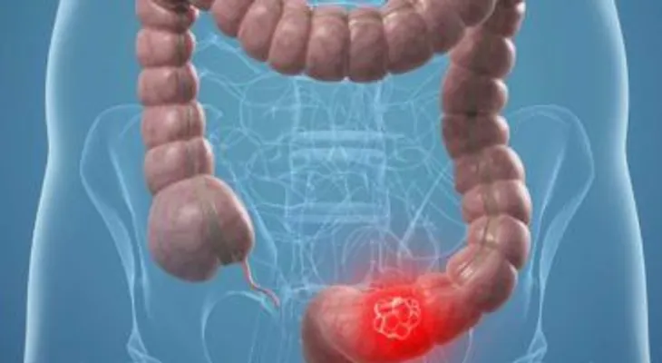 Descubren eficacia de árnica contra cáncer de colon