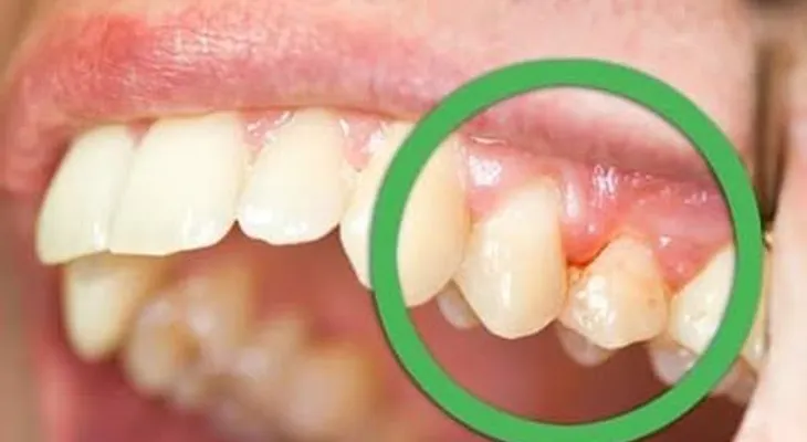 Remedios para la sensibilidad dental; recomendaciones (VIDEO)