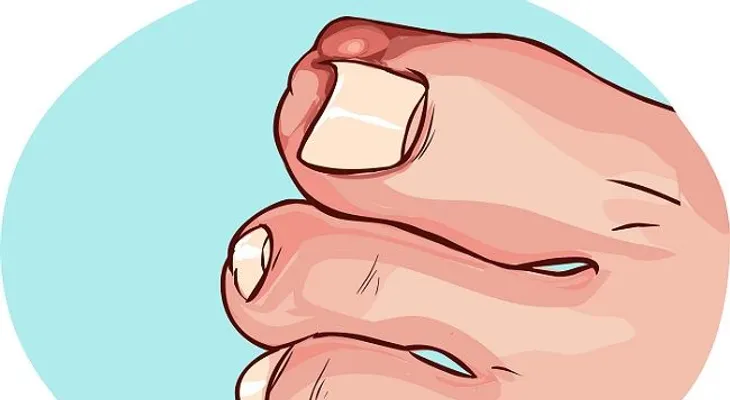 Remedios ancestrales para uñas enterradas o encarnadas