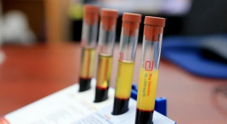 La sobrecarga de colesterol en el hígado causa tumores más agresivos, según estudio
