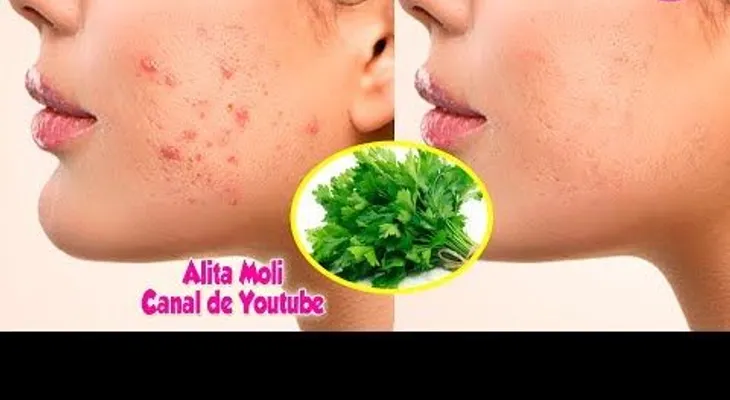 Increíble mascarilla con perejil para arrugas, manchas y acné