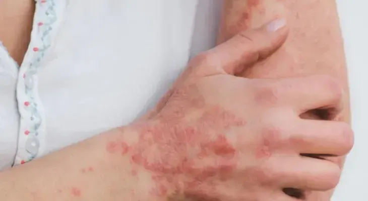 República Dominicana en alerta por peligrosa infección cutánea reportada en Haití
