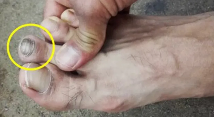¿Conoces a alguien que tenga este dedo más grande que los otros? ¡Mucho cuidado!