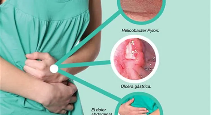 Anote estos remedios para la gastritis