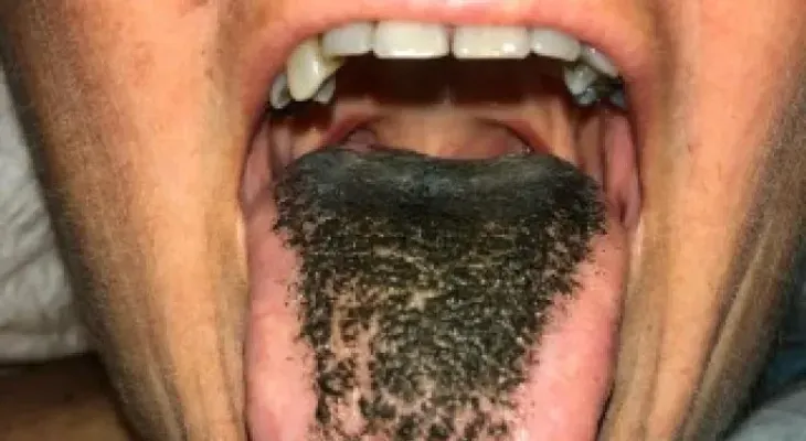 El "síndrome de lengua peluda negra" se produce por acumulación de células muertas en la piel
