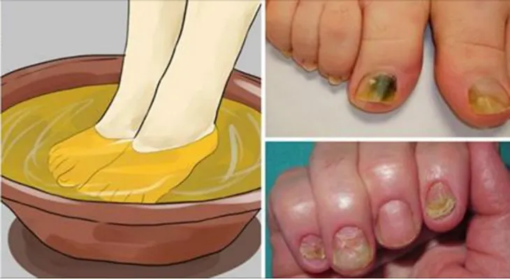 Remedio con 3 ingredientes para eliminar los hongos de las uñas, para toda la vida!!!? esto está buenísimo.