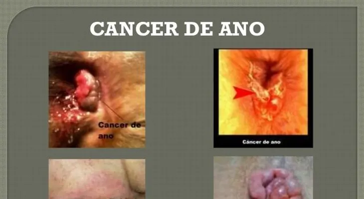 ¿Cómo se realiza el diagnóstico del cáncer de ano?