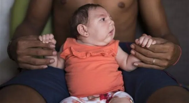 Nace en Hawaii un bebé con el virus zika