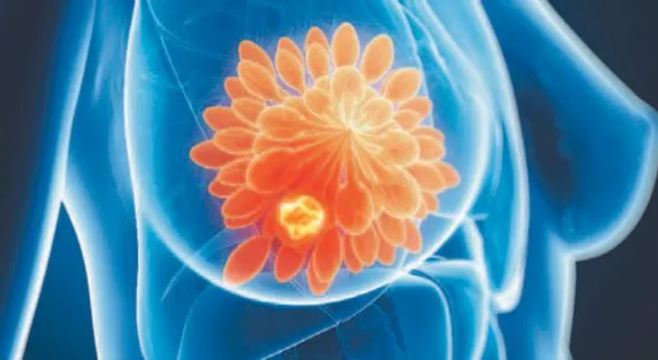 Identifican moléculas que crean resistencia a tratamientos del cáncer de mama