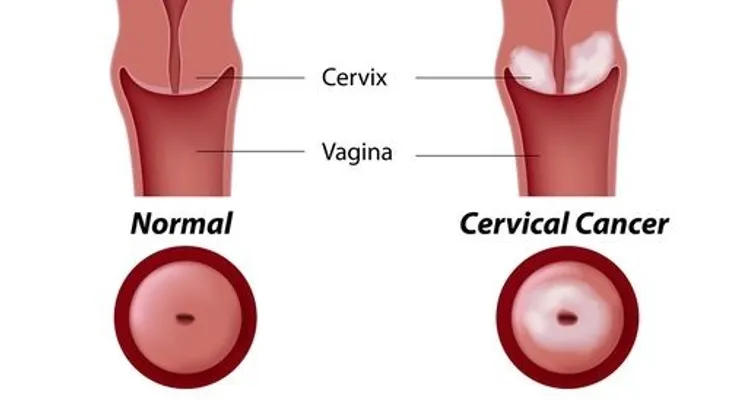 El virus del papiloma humano, causas y prevención
