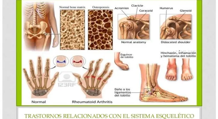 Las enfermedades del sistema esquelético