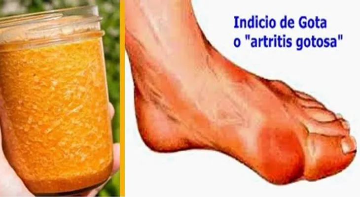 Dile Adiós a la gota o la artritis con este remedio casero! Por que no me lo dijeron antes
