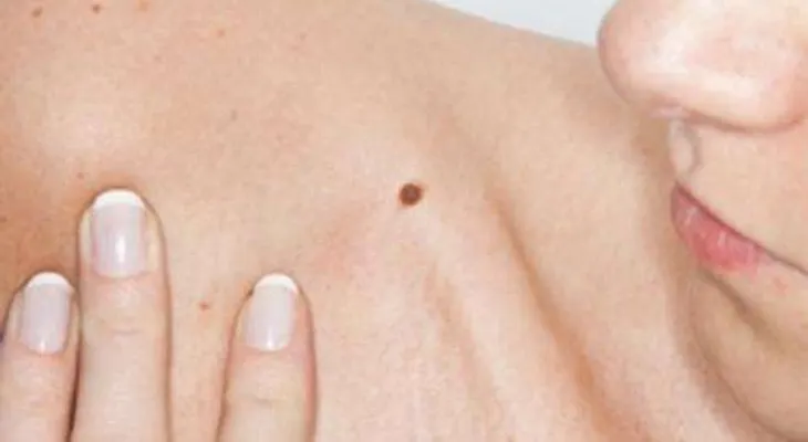 Diferencias entre lunares y verrugas
