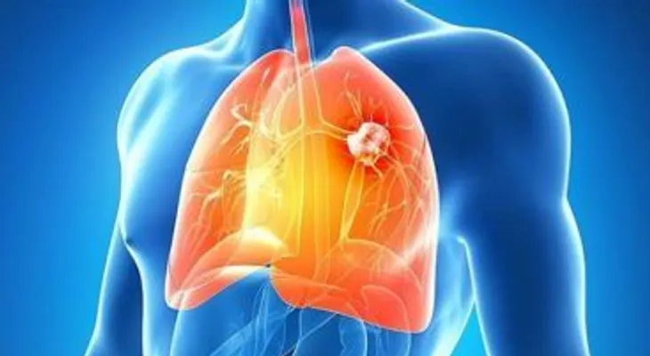 El 25 por ciento casos cáncer de pulmón desarrollan metástasis cerebral