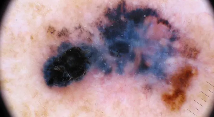 Merck y Moderna reportan avance en vacuna personalizada contra el melanoma, que podría allanar el camino a otras inmunizaciones oncológicas