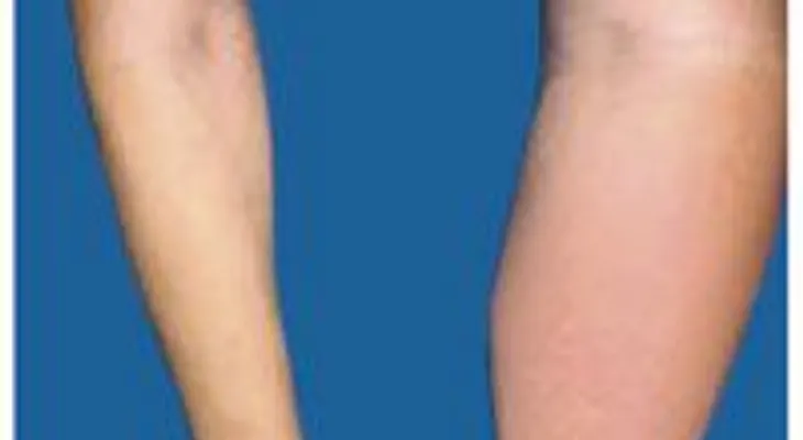 Acumulación de líquido o linfedema
