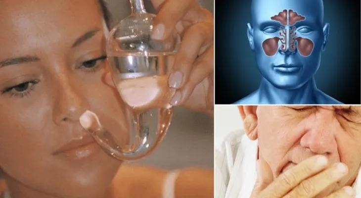 5 Tratamientos para la sinusitis 