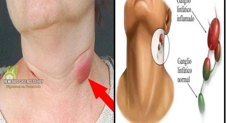 Desinflama los ganglios linfáticos en 5 minutos con este eficaz remedio 