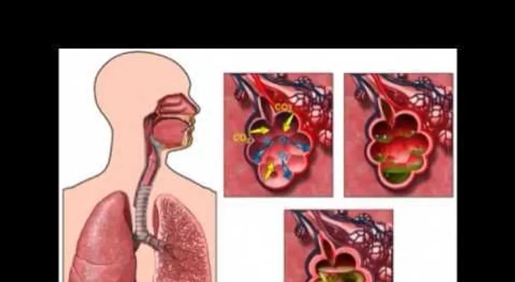 Bronquitis (VIDEO