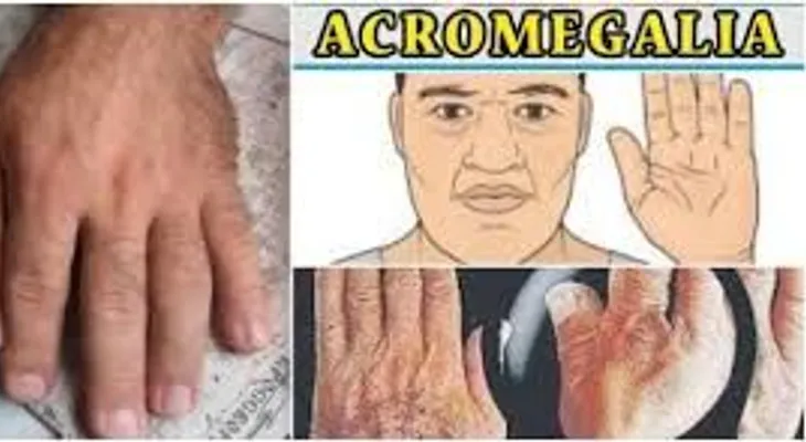 Acromegalia: enfermedad crónica que hace crecer manos, pies y rostro