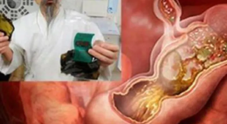 Médico japonés pública cómo eliminar la bacteria Helicobacter del organismo