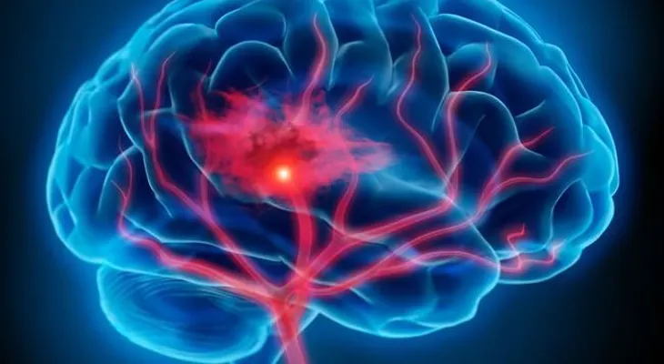 Crean un dispositivo que reduce secuelas en pacientes de parálisis cerebral