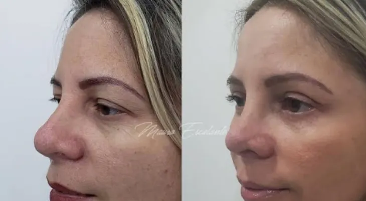  Procedimiento quirúrgico que logra rejuvenecer la piel casi se inmediato, la blefaroplastia