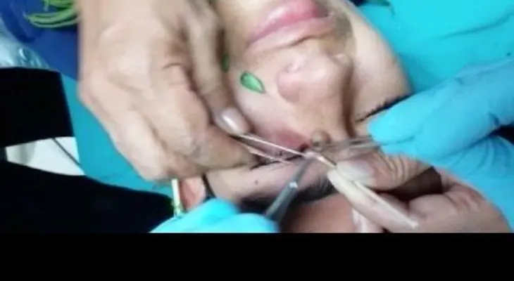 Extraen larva de mosca del ojo de un joven peruano (VIDEO)