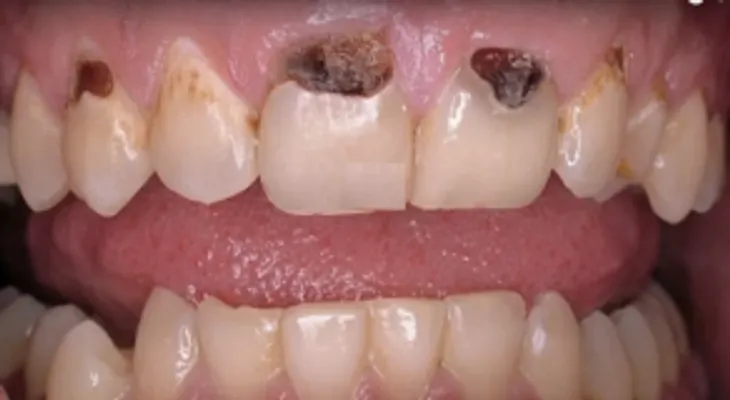 Las caries no serán nunca más un problema. ¡Tu dentista dirá cómo rayos lo hiciste!  (VIDEO)