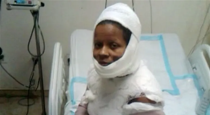 Mujer quemada junto a hijos abandona hospital Luis E.Aybar porque "no la atendían"