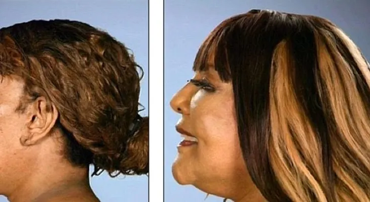 Una mujer se inyectó cemento en la cara; mira ahora su transformación 