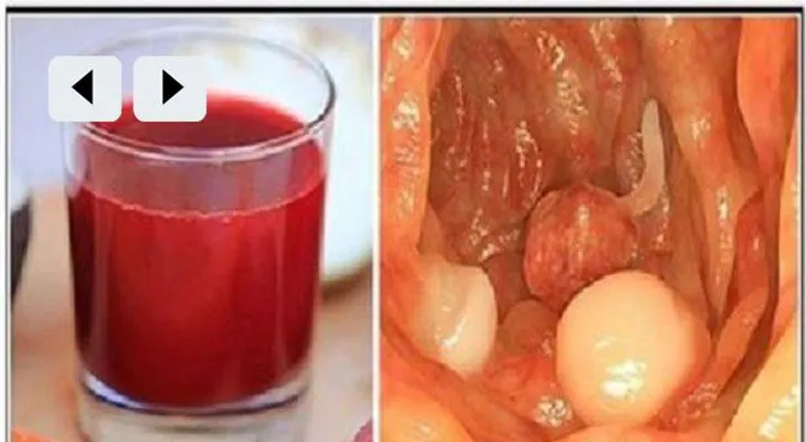 El cáncer muere dentro de las próximas 42 Horas ? Este jugo a curado más de 50 mil personas!