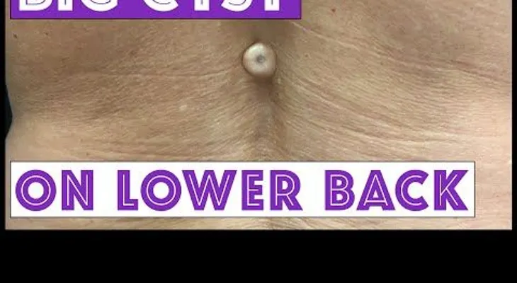 Ella tenía este tumor en la espalda, y los médicos no lo podían creer!