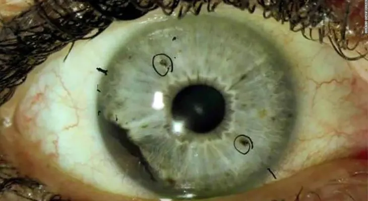 El extraño tipo de cáncer de ojo que tiene desconcertados a los expertos