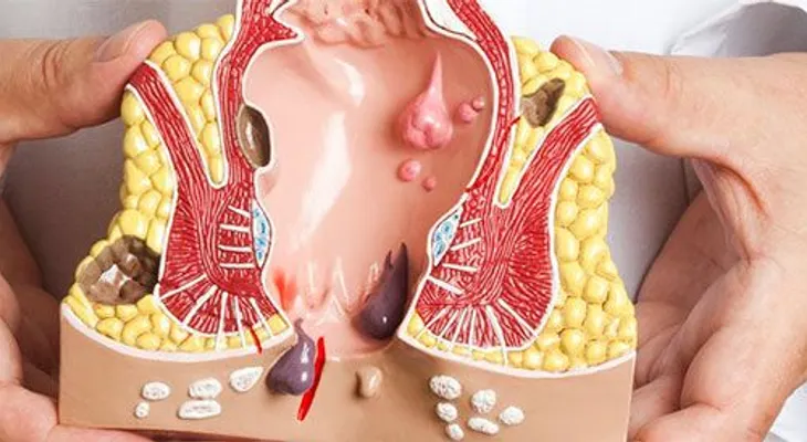 El cáncer del ano puede ser letal y muchos no lo saben: JAMÁS LO HUBIERA IMAGINADO