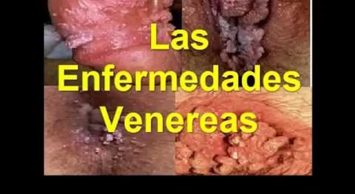 Síntomas de enfermedades venéreas (VIDEO)