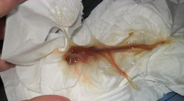¿Qué causa el moco cervical marrón ? ¿Debes preocuparte?