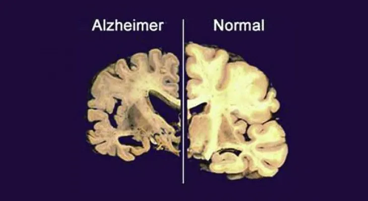 5 cosas que no sabías sobre el Alzheimer