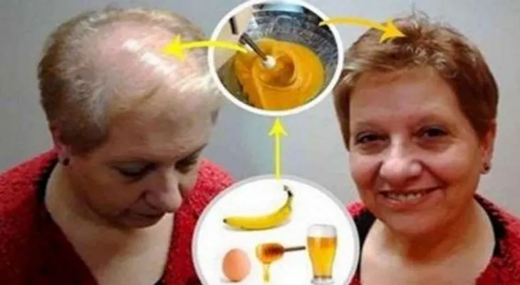 Doctores con la boca abierta con esta receta para crecer el cabello