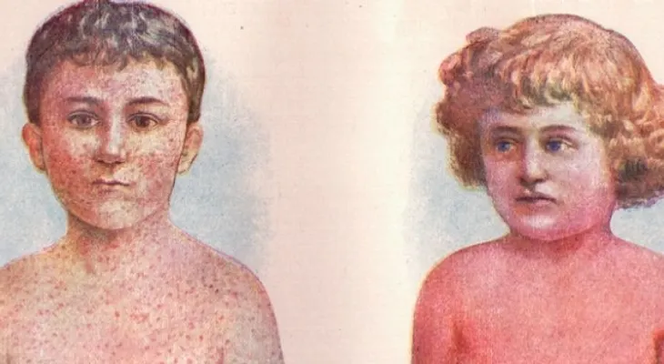 La fiebre escarlata enfermedad del siglo XIX regresa con una fuerte intensidad 