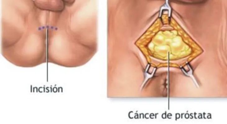 Cloruro de magnesio alarga la juventud, previene y cura la próstata