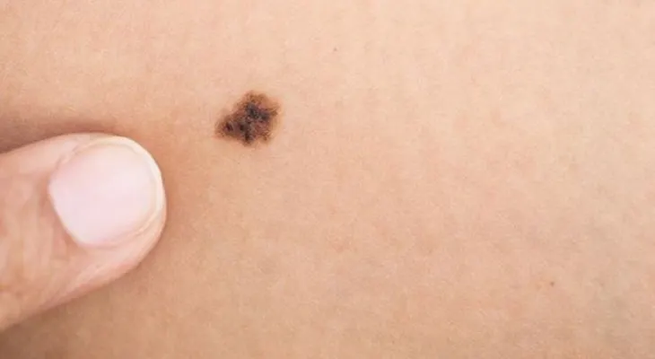 Las mujeres son más propensas a padecer melanoma