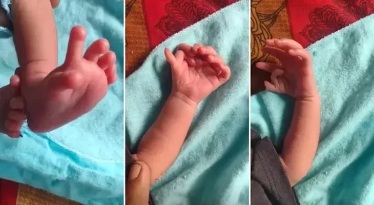 Padres con bebé de 26 dedos creen que se reencarnó en una diosa hindú