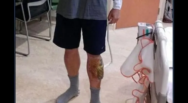 Increíble: Lo muerde una serpiente, lo ataca un tiburón y dos monos, le cae un rayo, y sobrevive