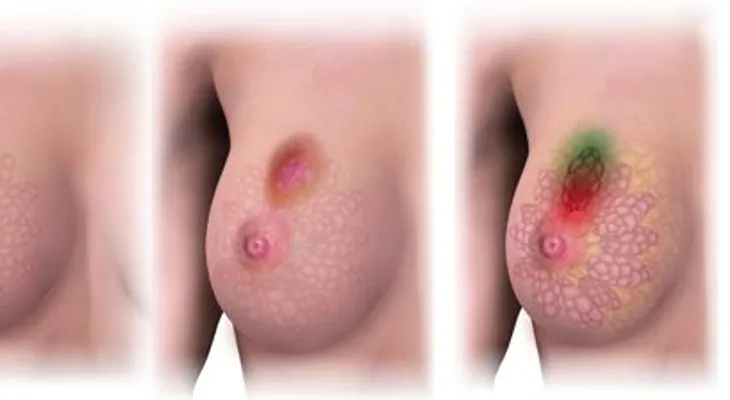 ¿Sabías que cuatro de cada diez tumores se pueden prevenir?