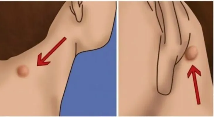 Si tienes esta pelotita detrás de tus oídos elimínala rápido con este remedio porque esto significa?