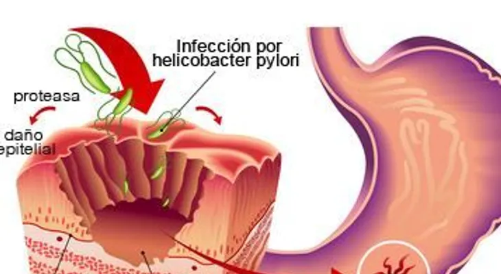 La gastritis, causas y síntomas