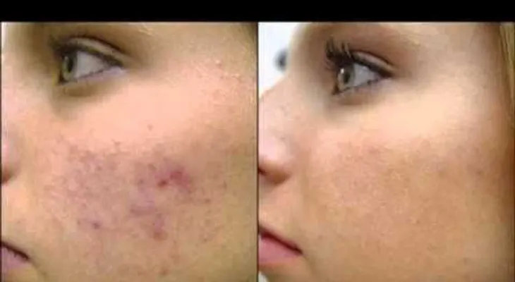 Peeling casero borras el acne, panÌ?os, cicatrices, estrías y cualquier tipo de manchas 